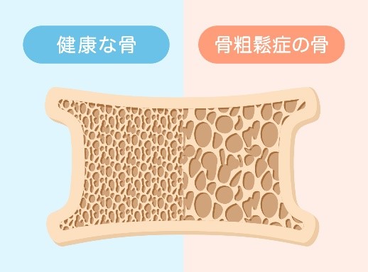 健康な骨と骨粗鬆症の骨